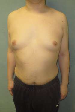 Dr. Blau's patient results for gynecomastia/breast reduction in New York City