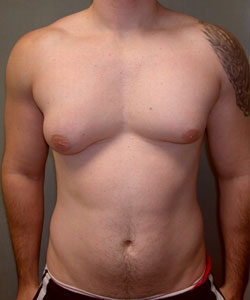 asymmetric breast surgery for men