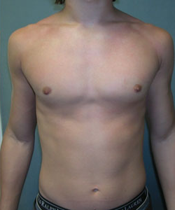 gynecomastia before & after