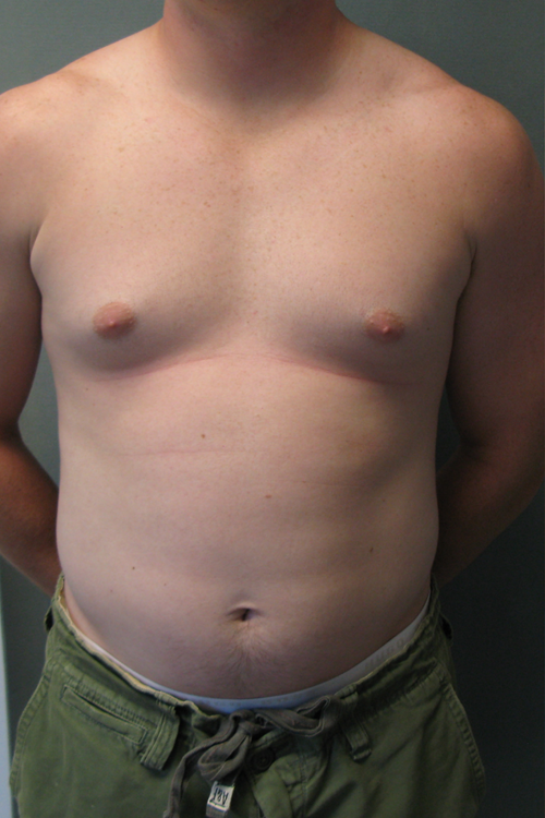 Puffy Nipples Before & After Photos Case # 40 - 1