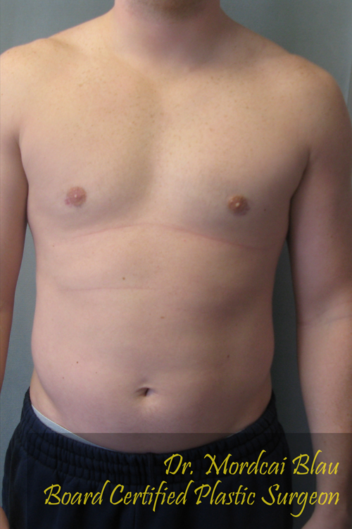 Puffy Nipples Before & After Photos Case # 40 - 1