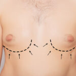 What Causes Gynecomastia in Adolescents?